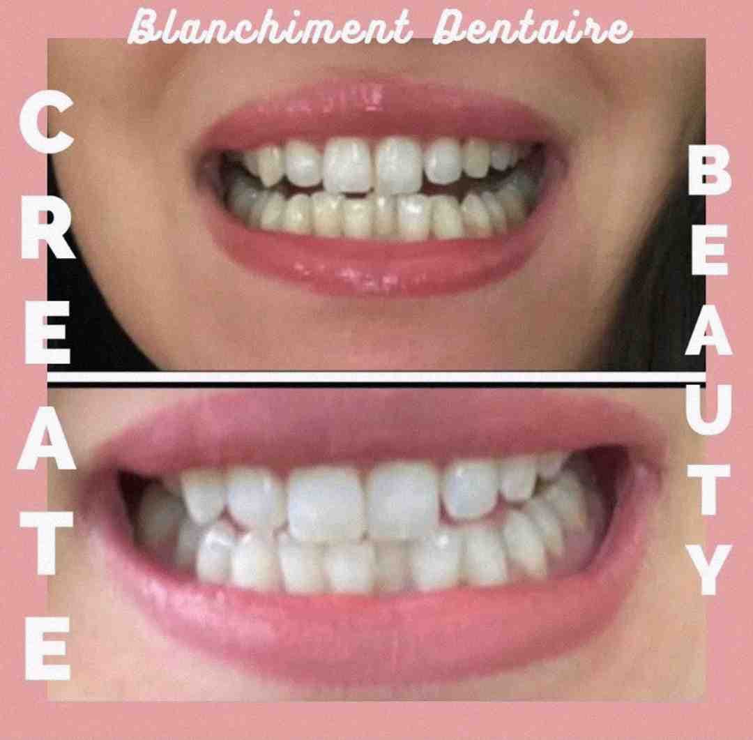 Blanchiment dentaire