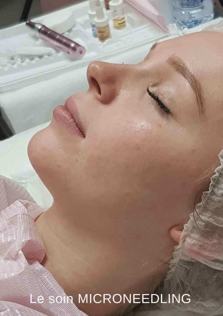 Soin de peau Microneedling — Sublimez votre peau avec Microneedling
