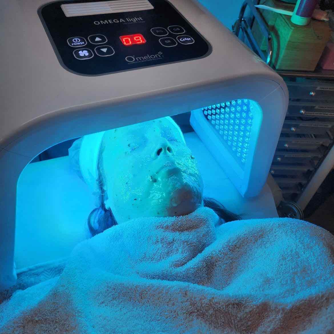 Séance Microneedling