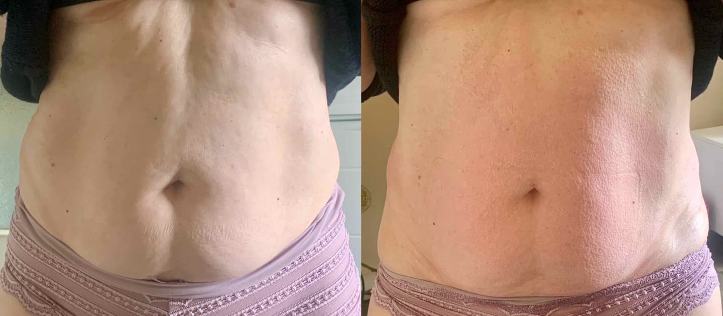 Maderotherapie — techniques combinées pour donner un coup de boost au résultat. Résultat après la séance 😍